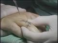 Primary view of [News Clip: Knuckle surgery]
