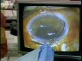 Video: [News Clip: Eye surgery]