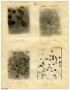 Image: [Four Photographs of B. J.'s Sickle-Cell Anemia from Six Hours to For…
